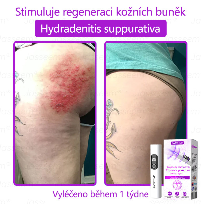 Jasseem® Pokročilá neinvazivní CO₂ laserová tužka pro obnovu pleti 🎉🎉 (Šetrně odstraňuje bradavice, pigmentové skvrny, stařecké skvrny a kožní výrůstky – bez bolesti a komplikací!)