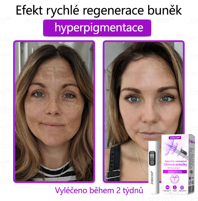 Jasseem® Pokročilá neinvazivní CO₂ laserová tužka pro obnovu pleti 🎉🎉 (Šetrně odstraňuje bradavice, pigmentové skvrny, stařecké skvrny a kožní výrůstky – bez bolesti a komplikací!)
