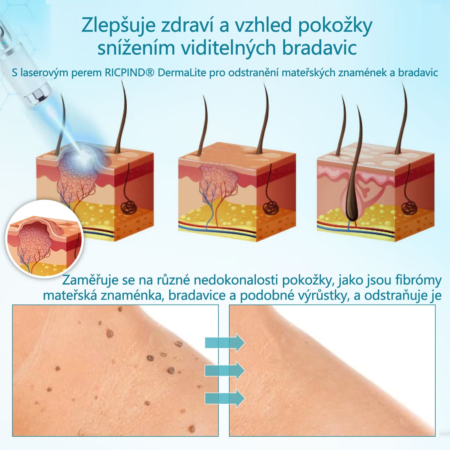 RICPIND® Laserové pero na bradavice a znaménka🔦 - neinvazivní a bezbolestné