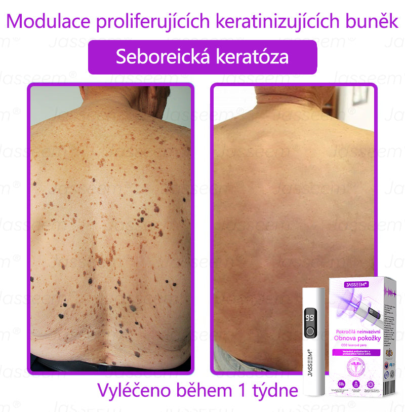 Jasseem® Pokročilá neinvazivní CO₂ laserová tužka pro obnovu pleti 🎉🎉 (Šetrně odstraňuje bradavice, pigmentové skvrny, stařecké skvrny a kožní výrůstky – bez bolesti a komplikací!)