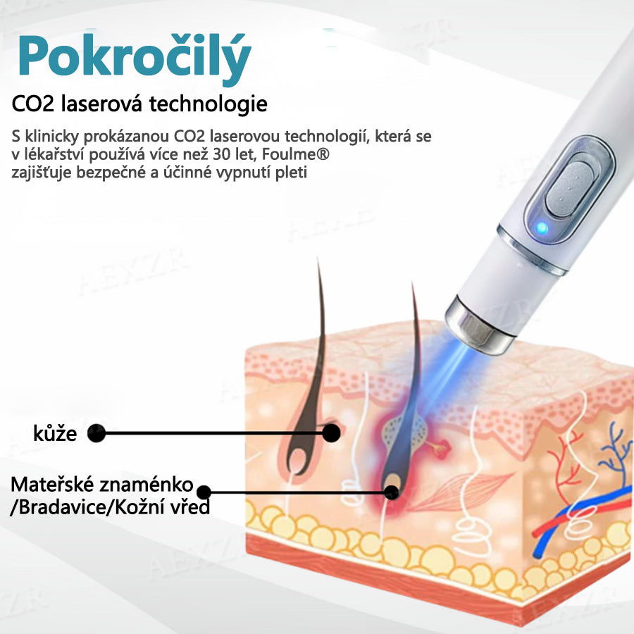 Foulme® Laserové pero na bradavice a znaménka🔦🔦 - neinvazivní a bezbolestné
