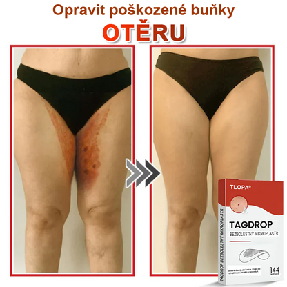 TLOPA® Mikroneedlové rostlinné náplasti na odstranění bradavic a kožních výrůstků