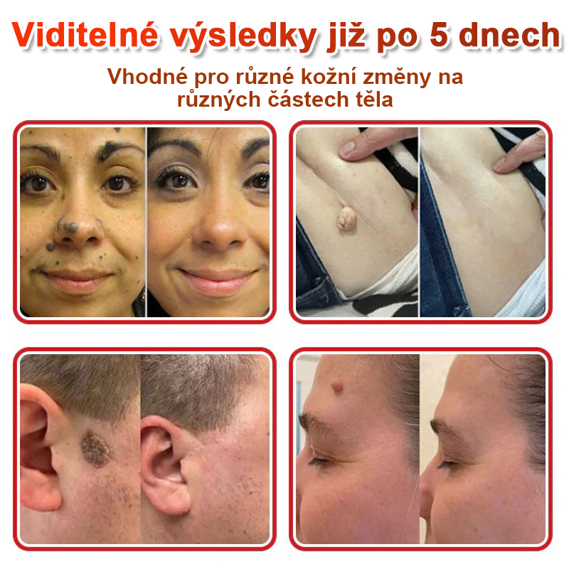 TLOPA® Mikroneedlové rostlinné náplasti na odstranění bradavic a kožních výrůstků