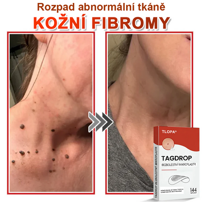 TLOPA® Mikroneedlové rostlinné náplasti na odstranění bradavic a kožních výrůstků