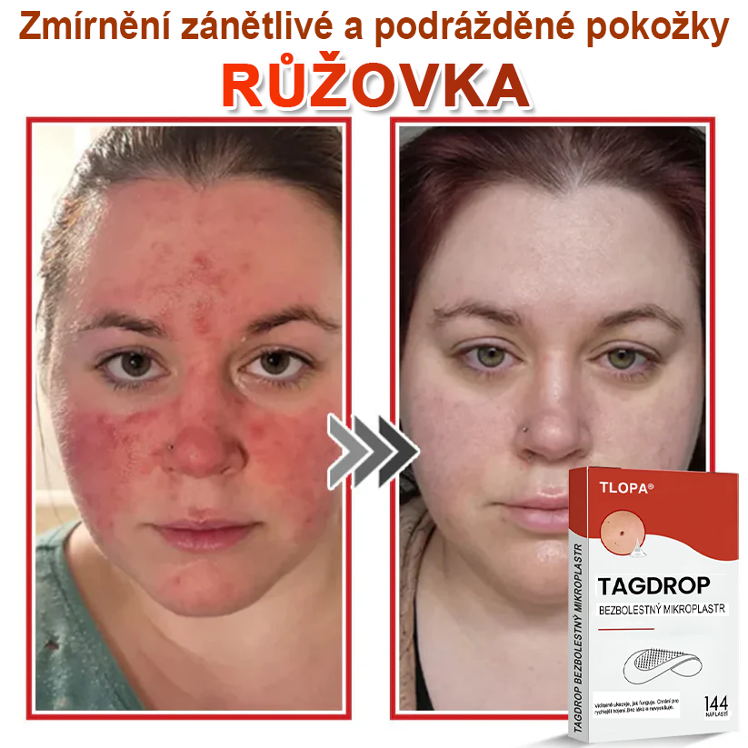 TLOPA® Mikroneedlové rostlinné náplasti na odstranění bradavic a kožních výrůstků