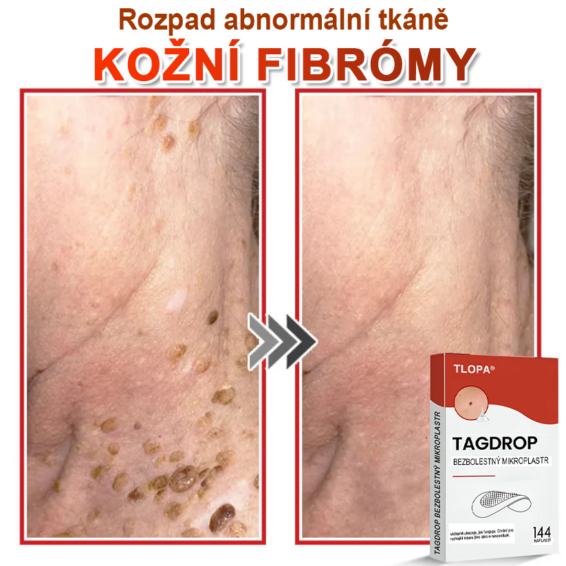 TLOPA® Mikroneedlové rostlinné náplasti na odstranění bradavic a kožních výrůstků