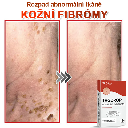 TLOPA® Mikroneedlové rostlinné náplasti na odstranění bradavic a kožních výrůstků