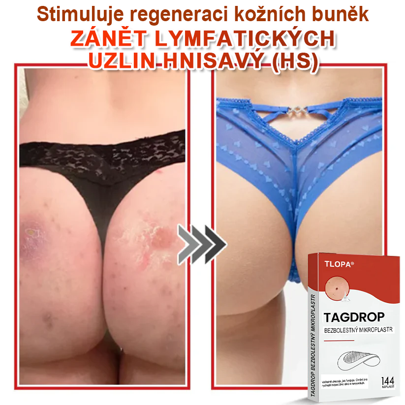 TLOPA® Mikroneedlové rostlinné náplasti na odstranění bradavic a kožních výrůstků