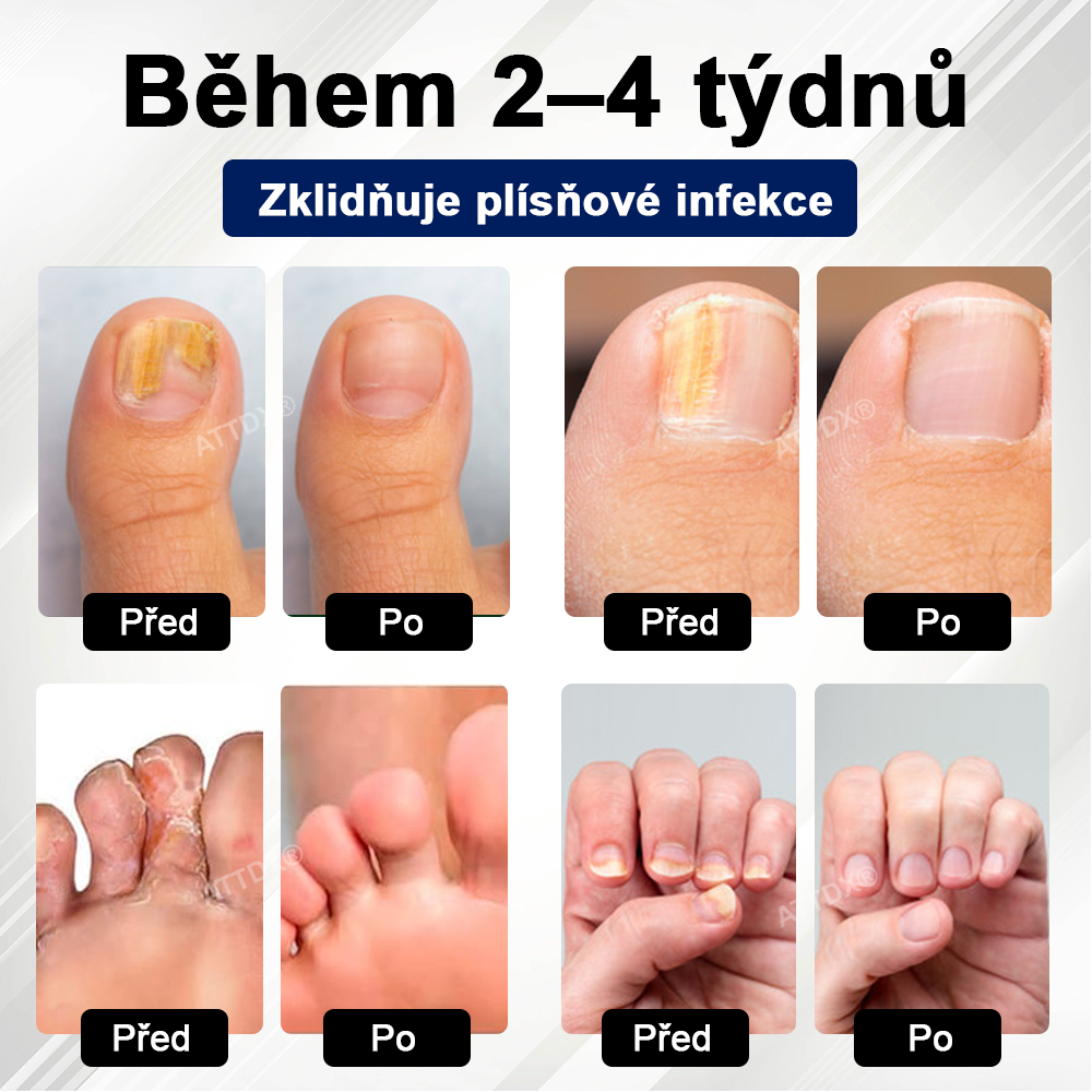 ATTDX® Fungiclear Sprej na nehty s včelí terapií✨✨