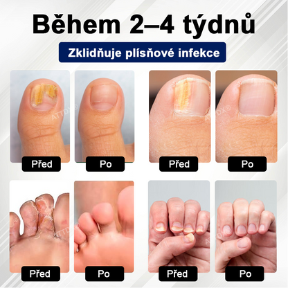 ATTDX® Fungiclear Sprej na nehty s včelí terapií✨✨
