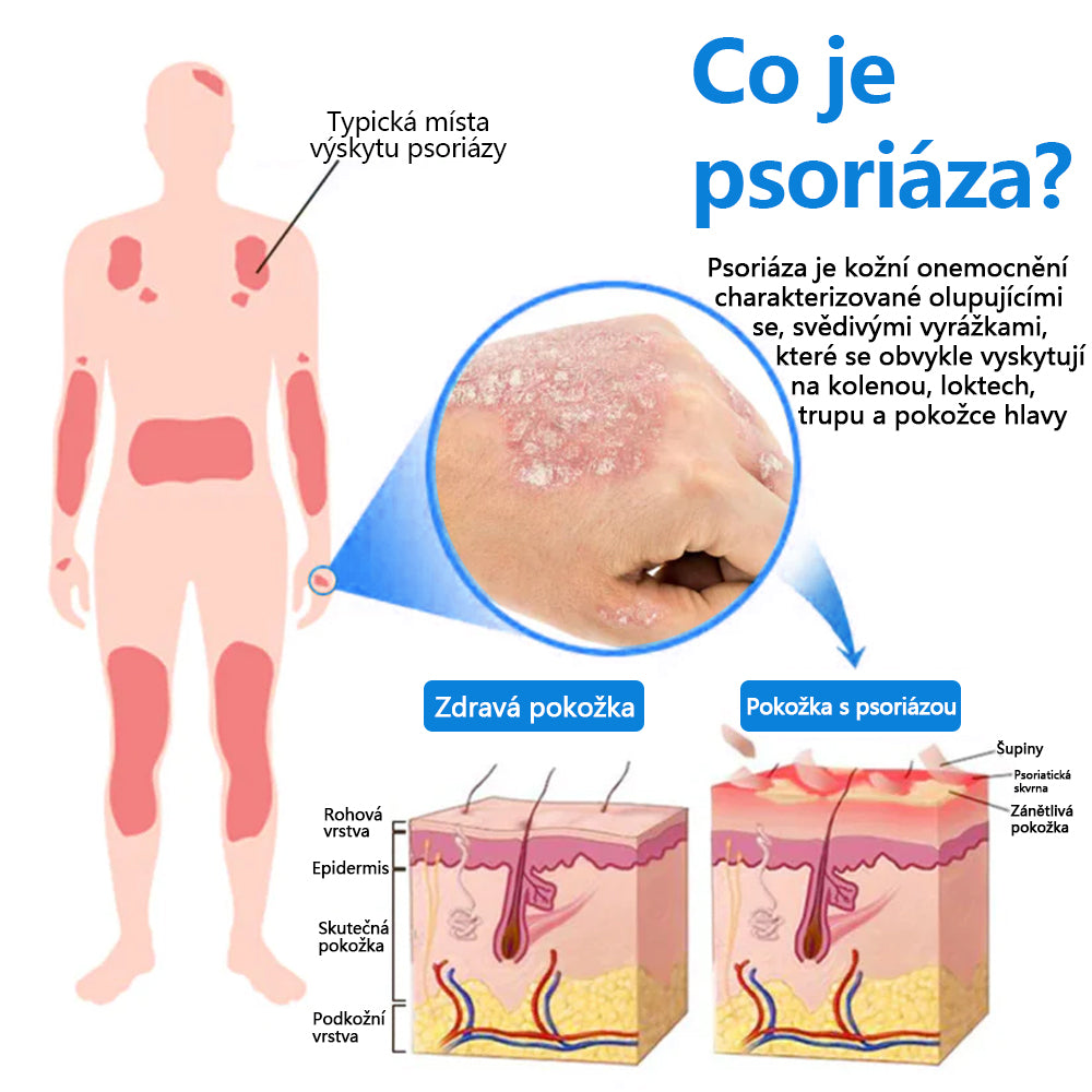 ✅Zvoevo® Magnesium bylinný sprej ⚕️ Certifikace MHRA – úleva při psoriáze, ekzému, intimních bakteriálních infekcích, akné a tmavých skvrnách✨
