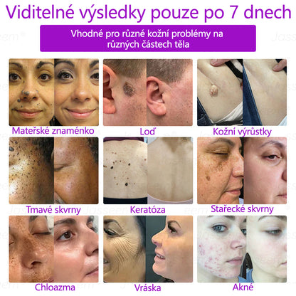 Jasseem® Pokročilá neinvazivní CO₂ laserová tužka pro obnovu pleti 🔦🔦 (Šetrně odstraňuje bradavice, pigmentové skvrny, stařecké skvrny a kožní výrůstky – bez bolesti a komplikací!)