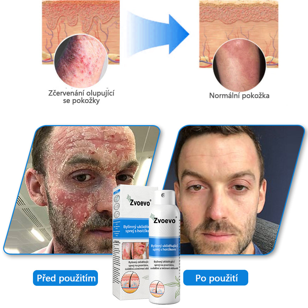 ✅Zvoevo® Magnesium bylinný sprej ⚕️ Certifikace MHRA – úleva při psoriáze, ekzému, intimních bakteriálních infekcích, akné a tmavých skvrnách✨