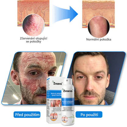 ✅Zvoevo® Magnesium bylinný sprej ⚕️ Certifikace MHRA – úleva při psoriáze, ekzému, intimních bakteriálních infekcích, akné a tmavých skvrnách✨