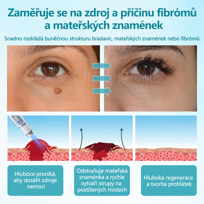 RICPIND® Laserové pero na bradavice a znaménka🔦🔦 - neinvazivní a bezbolestné