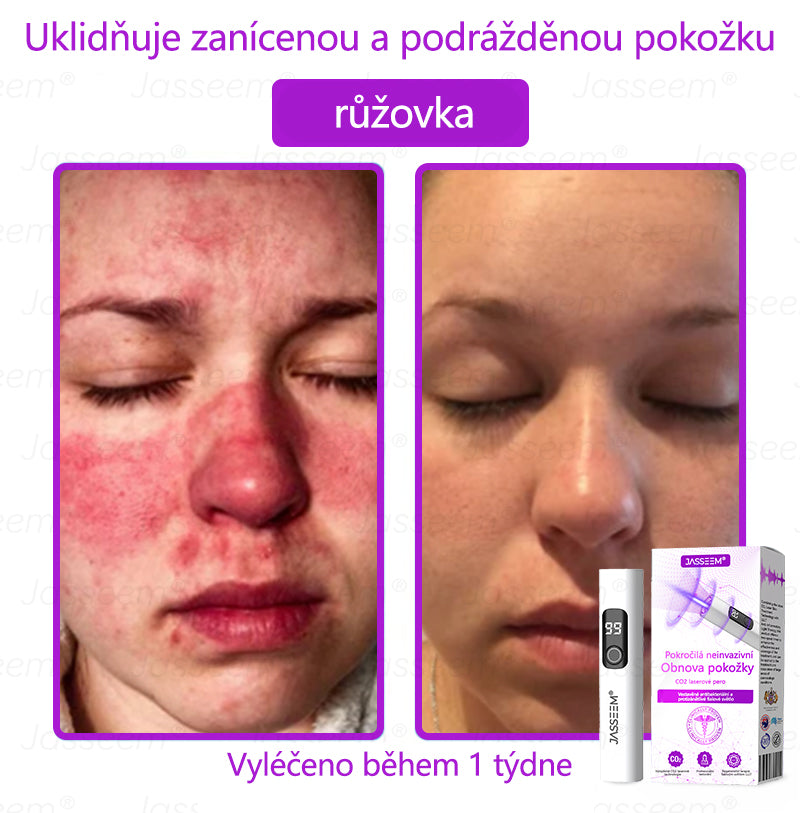 Jasseem® Pokročilá neinvazivní CO₂ laserová tužka pro obnovu pleti 🔦🔦 (Šetrně odstraňuje bradavice, pigmentové skvrny, stařecké skvrny a kožní výrůstky – bez bolesti a komplikací!)
