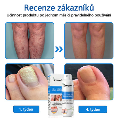 ✅Zvoevo® Magnesium bylinný sprej ⚕️ Certifikace MHRA – úleva při psoriáze, ekzému, intimních bakteriálních infekcích, akné a tmavých skvrnách✨