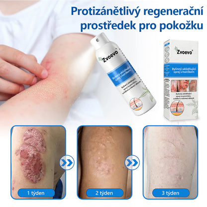 ✅Zvoevo® Magnesium bylinný sprej ⚕️ Certifikace MHRA – úleva při psoriáze, ekzému, intimních bakteriálních infekcích, akné a tmavých skvrnách✨