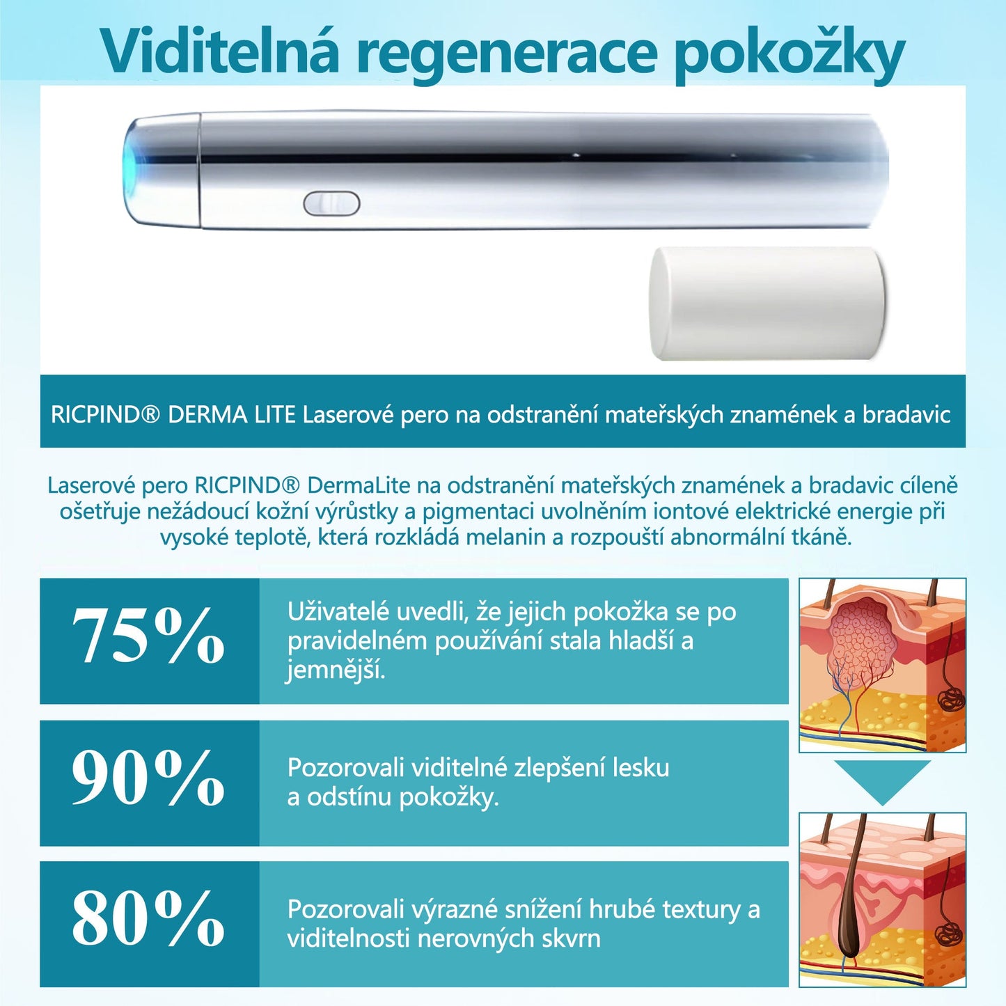 RICPIND® Laserové pero na bradavice a znaménka🔦🔦 - neinvazivní a bezbolestné