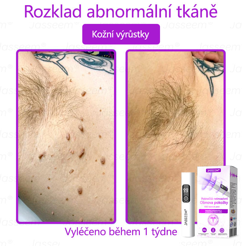 Jasseem® Pokročilá neinvazivní CO₂ laserová tužka pro obnovu pleti 🔦🔦 (Šetrně odstraňuje bradavice, pigmentové skvrny, stařecké skvrny a kožní výrůstky – bez bolesti a komplikací!)